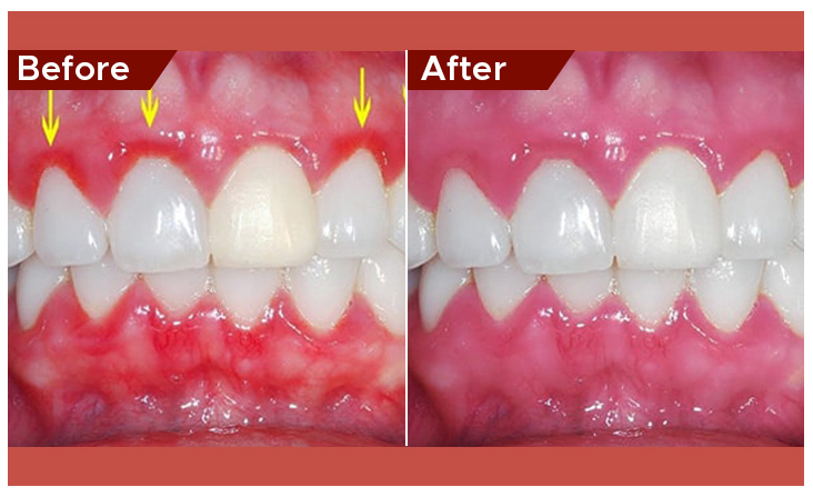 gum disease treatment in abu dhabi