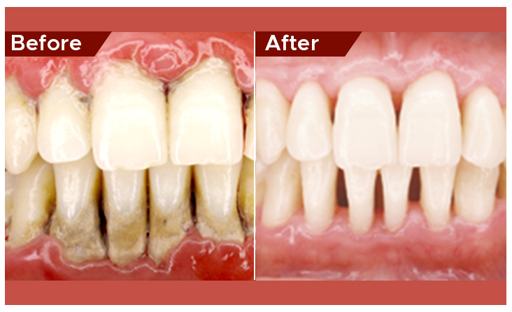 gum disease treatment in abu dhabi